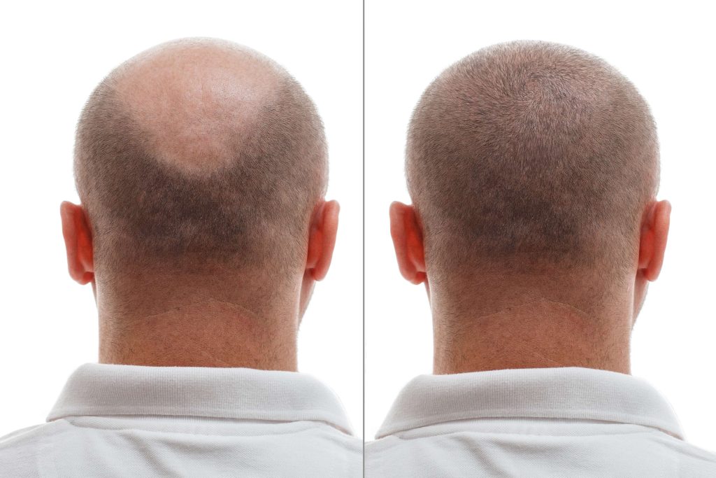 The,Head,Of,A,Balding,Man,Before,And,After,Hair