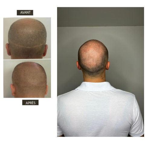 solution calcite masculine poste greffe de cheveux micro pigmentation effet rasé 3D